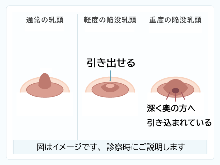 通常の乳頭、軽度の陥没乳頭、重度の陥没乳頭の模式図