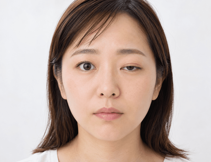 眼瞼下垂のイメージ