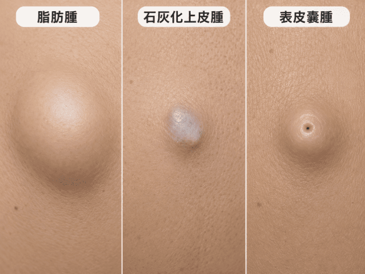 その他の皮膚腫瘍
